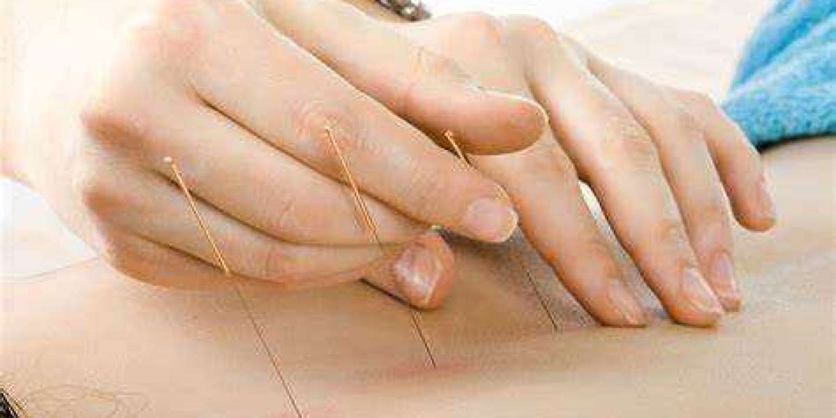 Reasons Why Acupuncture is Beneficial For You