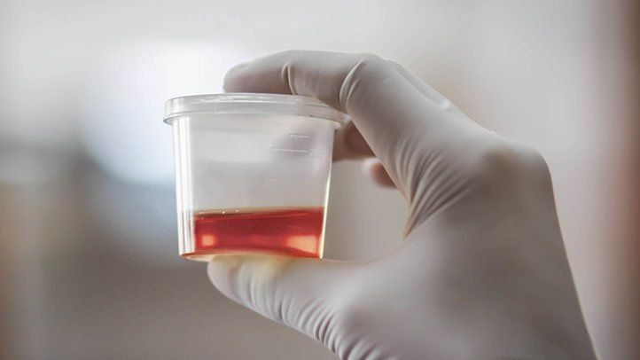 Seeing Red: What Blood in the Urine Might Mean for Men's Health