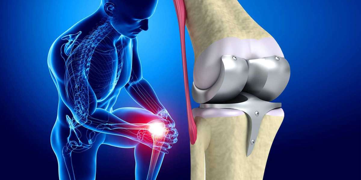 Knee Replacement Market Outlook on Industry Strategies to Grow Vigorously