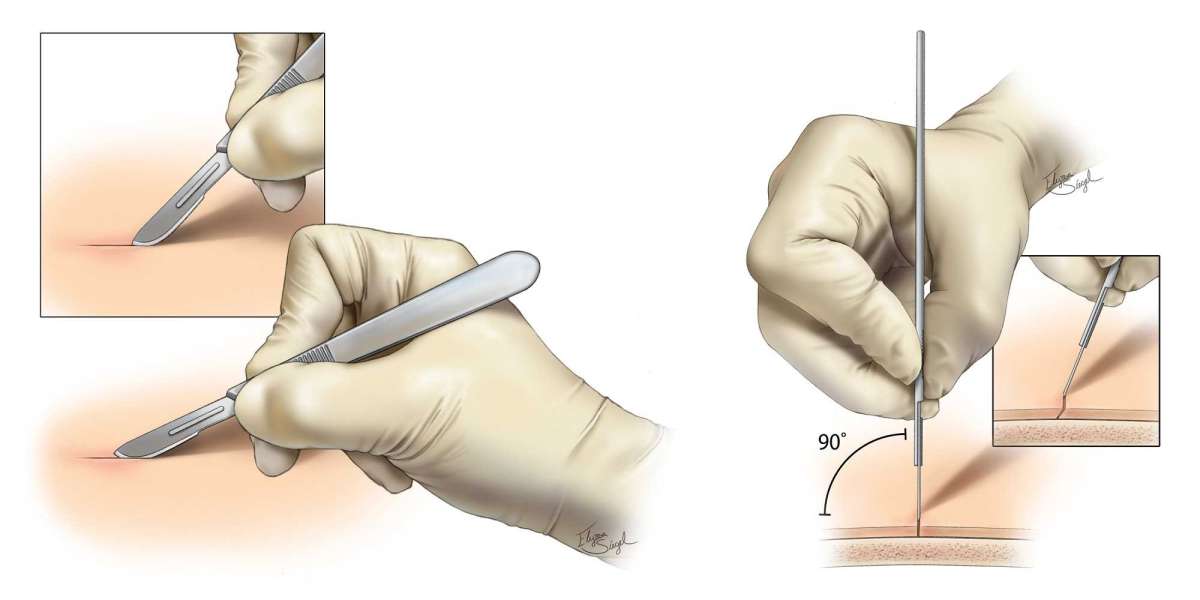Surgical Scalpel Market Outlook Report includes Global Industry Size & Forecasts