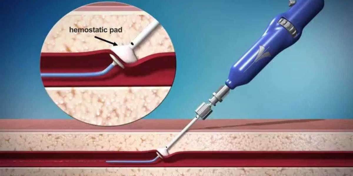 Global Vascular Closure Devices Market Value, Volume, Key Players, Revenue and Forecasts to 2026