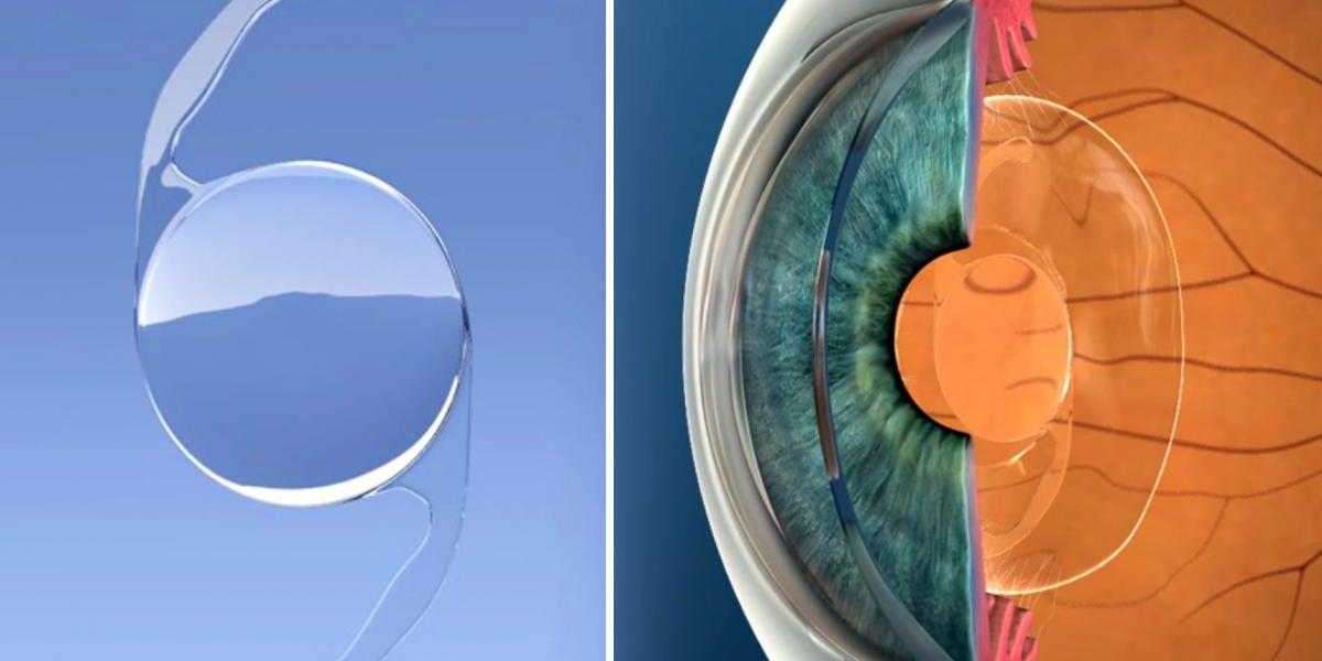 Intraocular Lens Market Outlook including Industry Size, Share & Growth