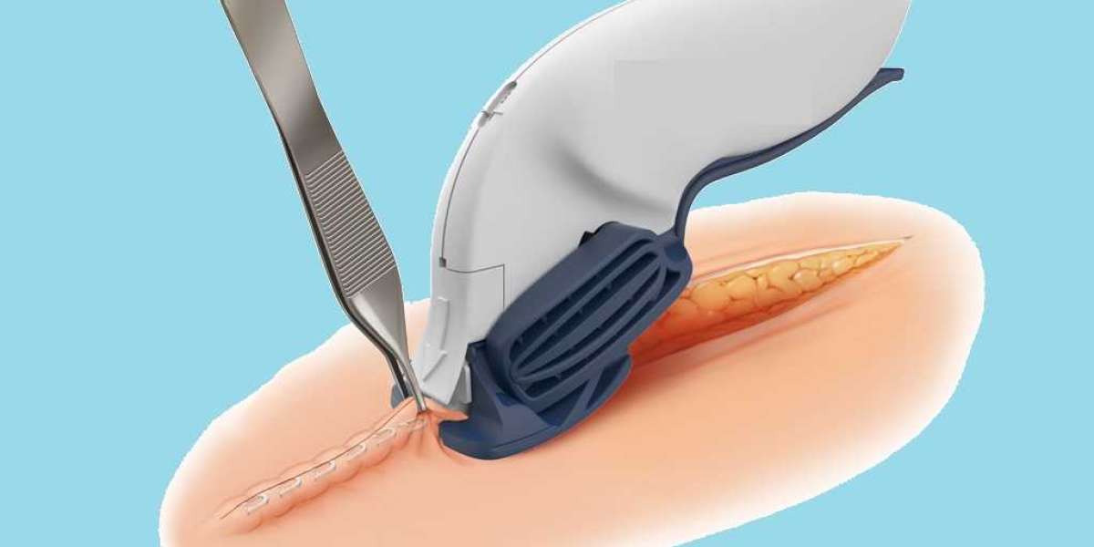 Surgical Staplers Market Outlook portrays the Industry Benefits from Technological Advancements