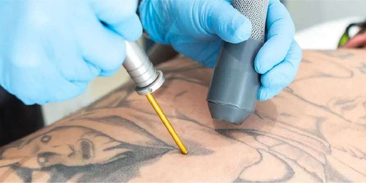 Saying Goodbye to Ink: Top Tattoo Removal Markets - Japan, S. Korea, UK & Australia