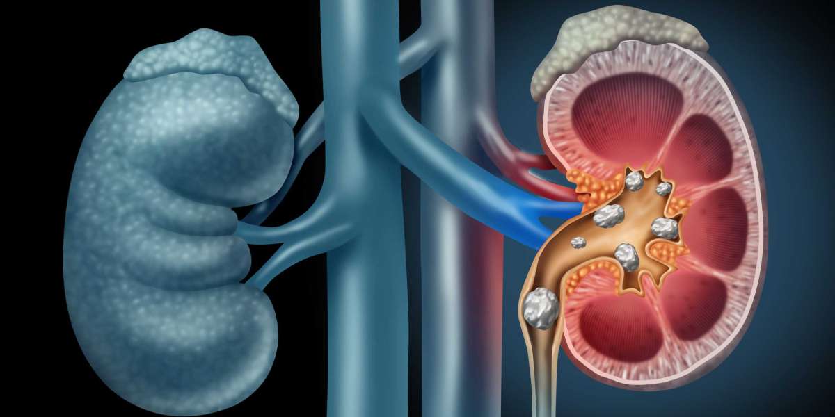 Kidney Cancer Market Key Industry Segments Poised for Strong Growth in Future 2034