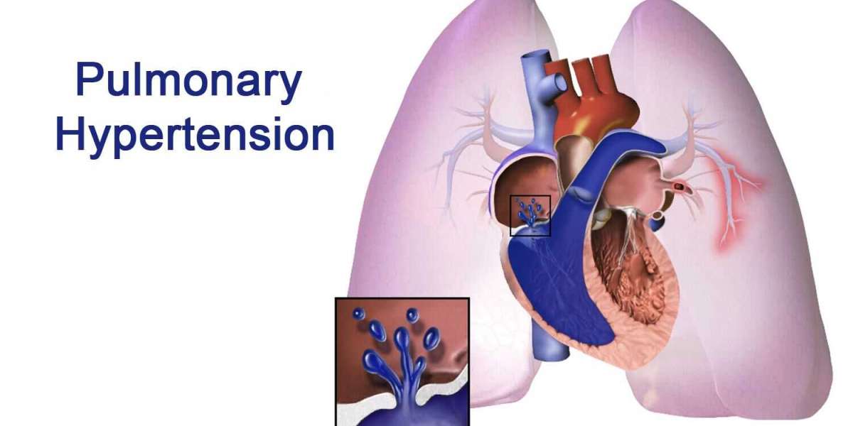 Pulmonary Arterial Hypertension Market — Global Industry Trends, Growth, Opportunities and Forecasts 2033