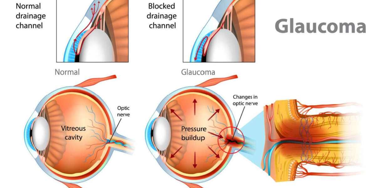 Glaucoma Market Overview, Analysis, And Industry Growth Report 2033