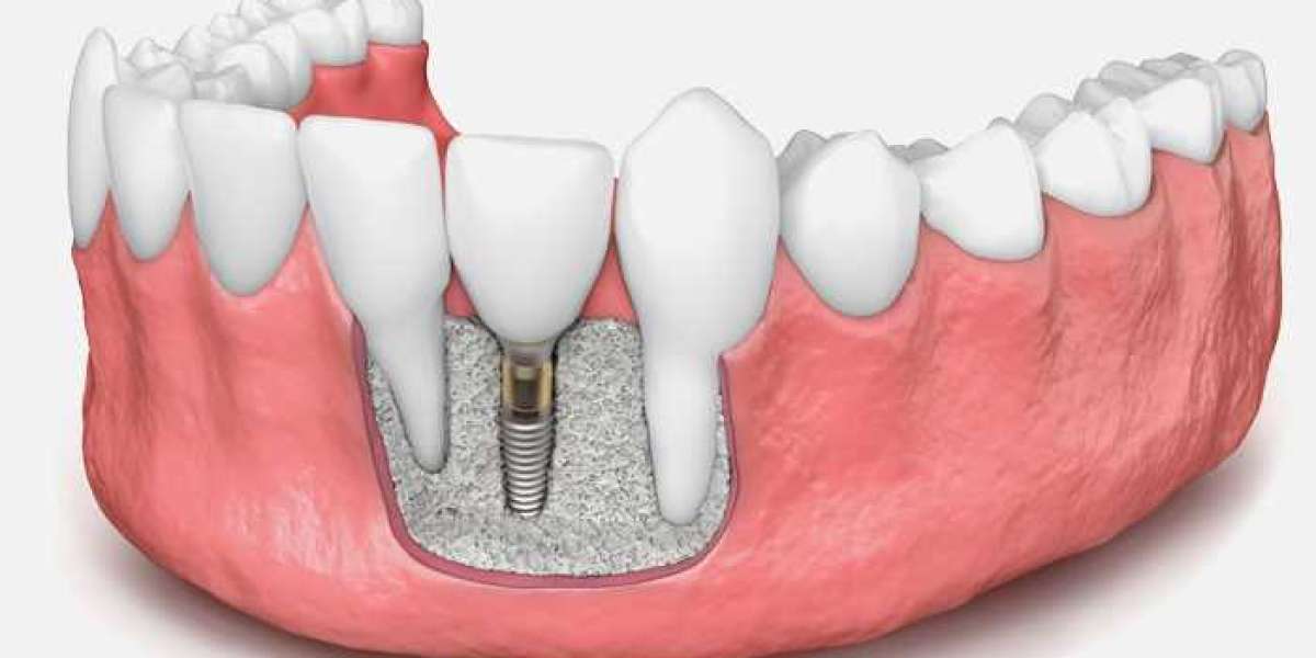 Dental Bone Graft Substitute Market Insights: Comparing Xenograft and Allograft