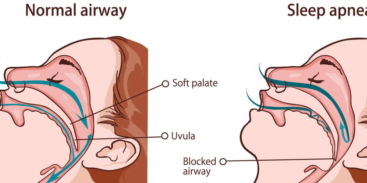 Conquer Sleep Apnea: Home vs. Lab Treatment - Choosing What's Right for You