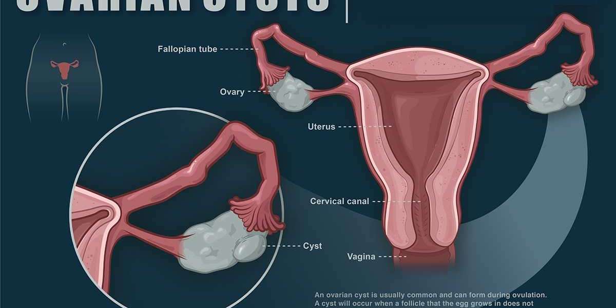 Minimally Invasive Surgery: Boston Scientific’s Impact on Ovarian Cyst Management