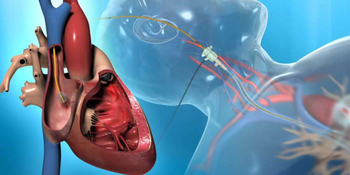 Abbott’s AdvisorTM HD Grid Catheter: Enhancing Precision in Cardiac Catheterization Procedures