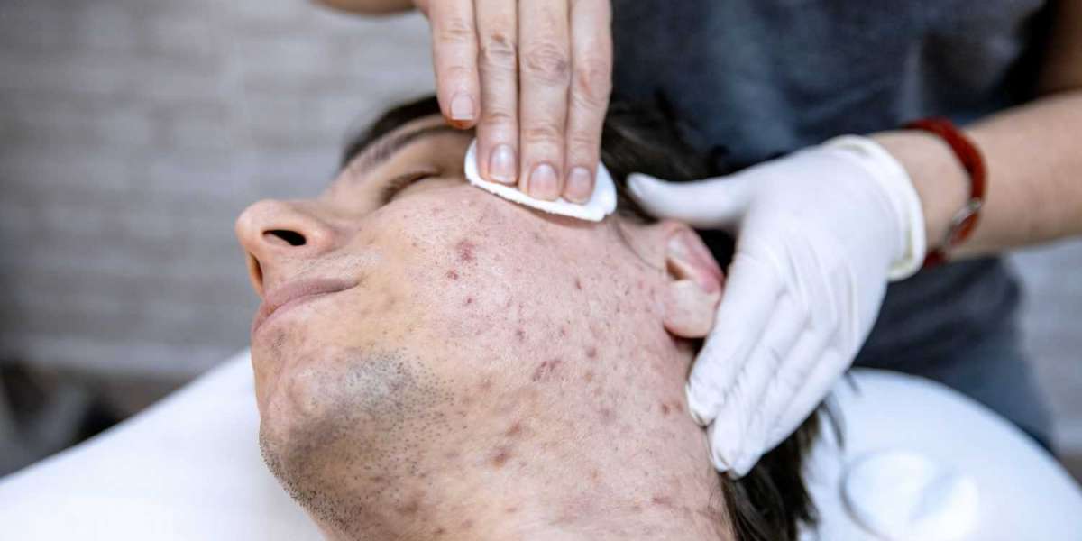 Acne Treatment Market Size To Grow USD 16,890 Million By 2033| CAGR of 5.6%